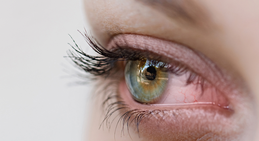 Болезнь Шегрена: причины, симптомы, лечение