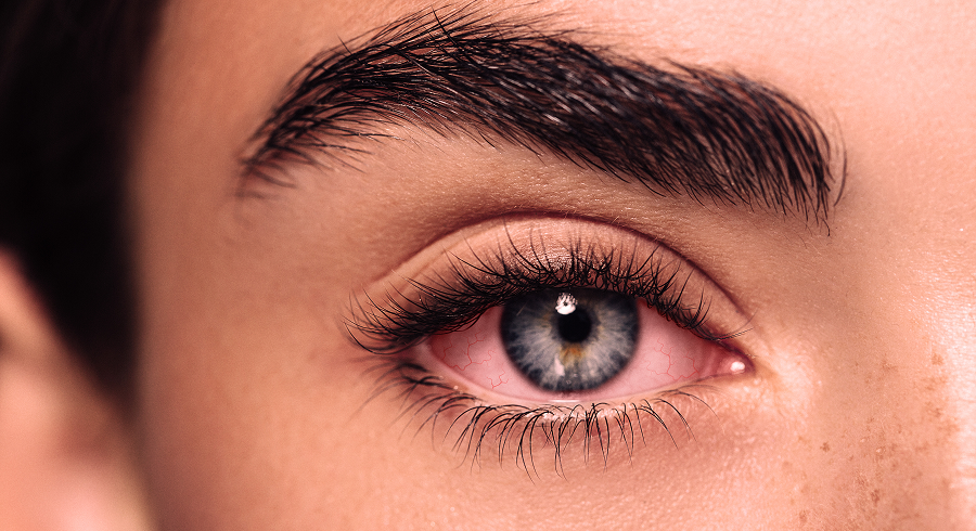 Гиперемия конъюнктивы: причины, симптомы, лечение