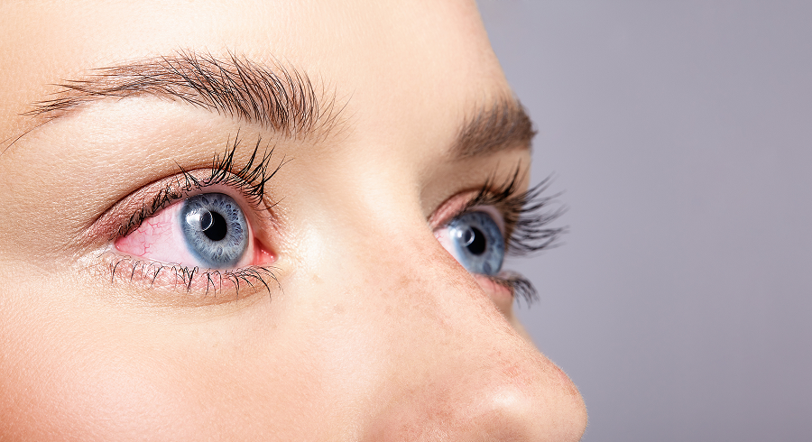 Ощущение соринки в глазу